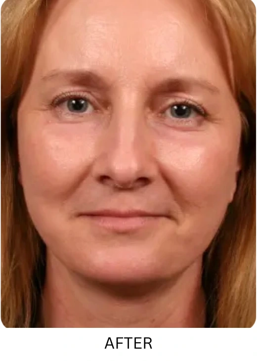 Facelift & Neck Lift Before & After Results images