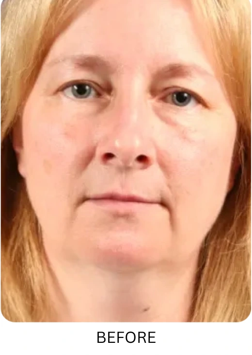 Facelift & Neck Lift Before & After Results images