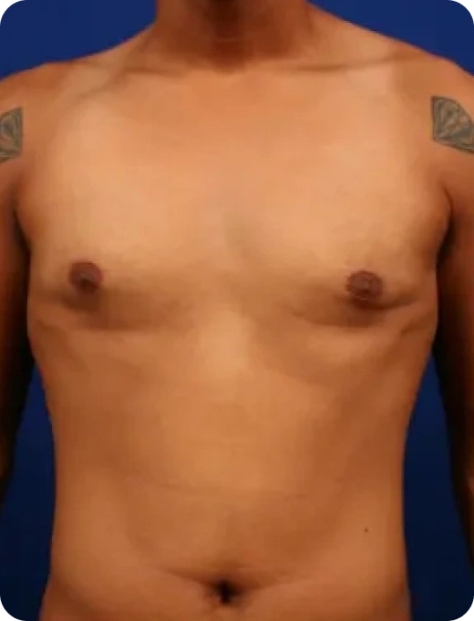 Breast Augmentation Before & After Banner