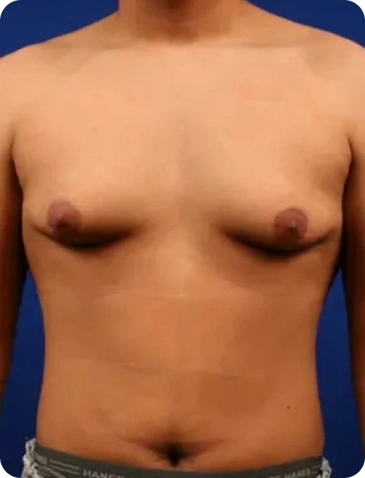 Breast Augmentation Before & After Banner
