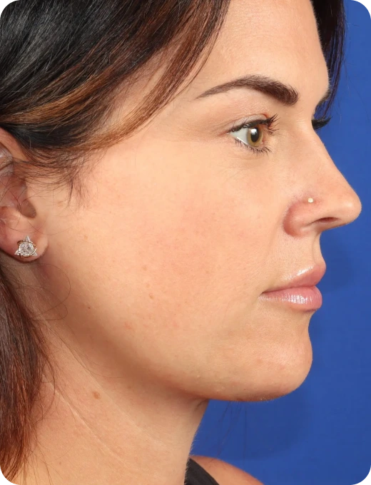 Deep Plane Neck Lift Before & After Banner