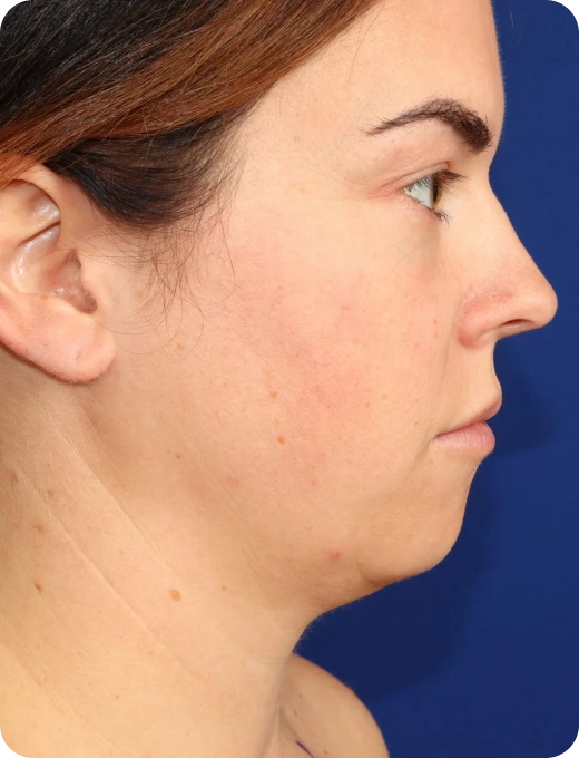 Deep Plane Neck Lift Before & After Banner