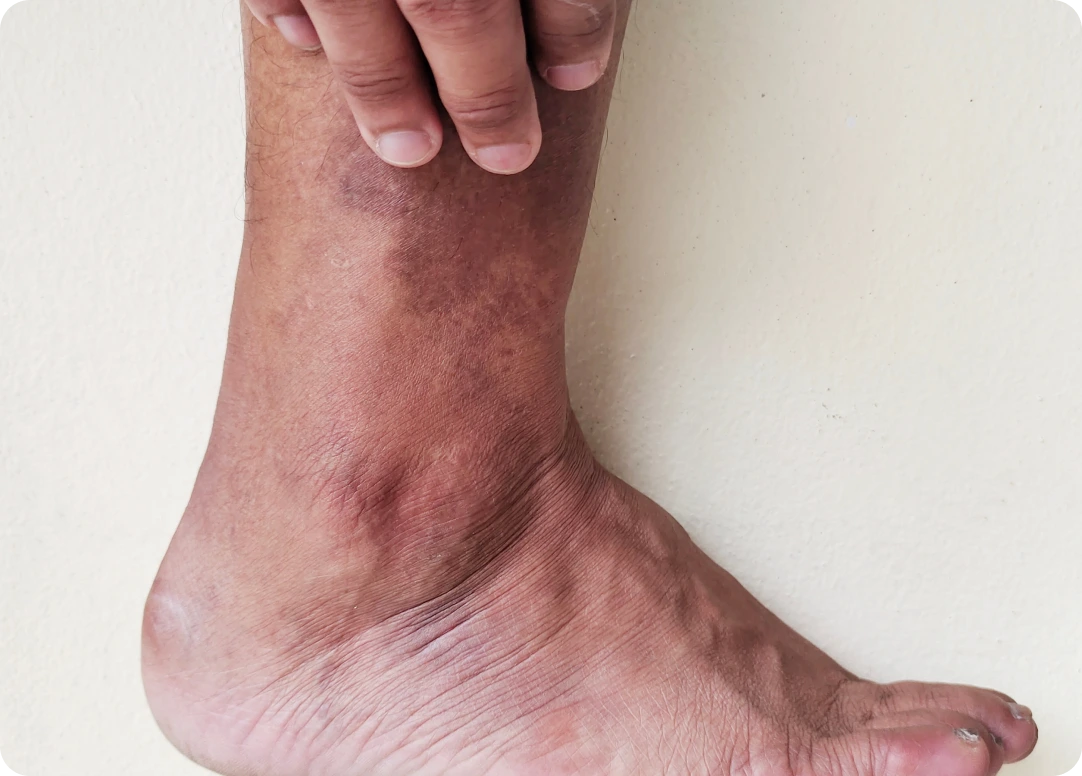 About Leg Ulcers Banner