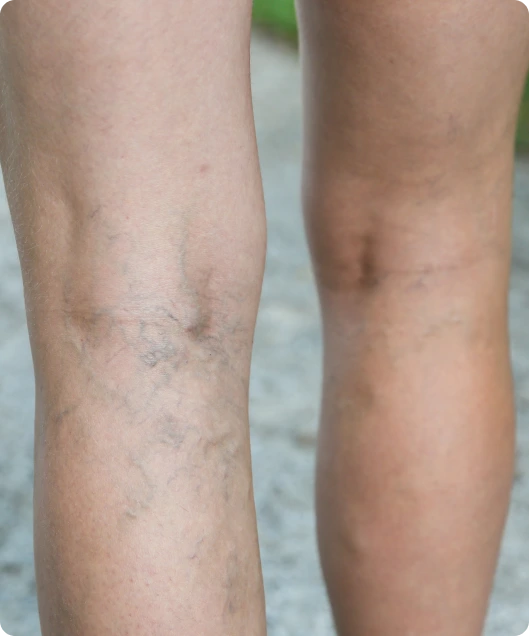 Springfield MO Vein Treatment: Reticular Veins Banner