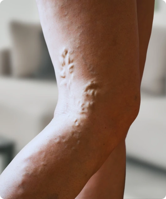 Vein Treatment Springfield, MO: Varicose Veins Banner