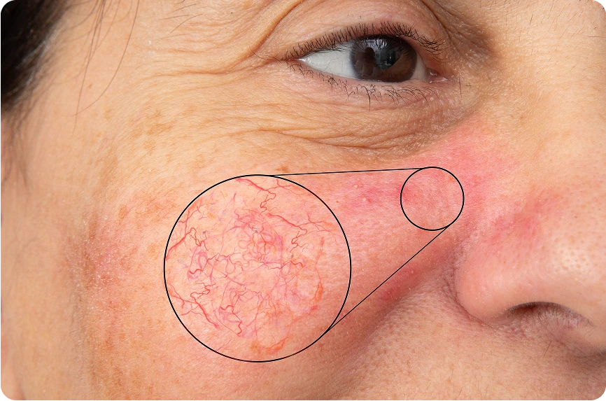 What Are Facial Veins In Springfield, MO Banner