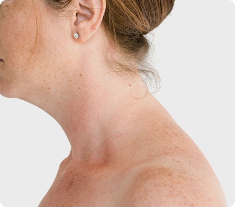 Preparation for Buffalo Hump Liposuction Springfield, MO Banner