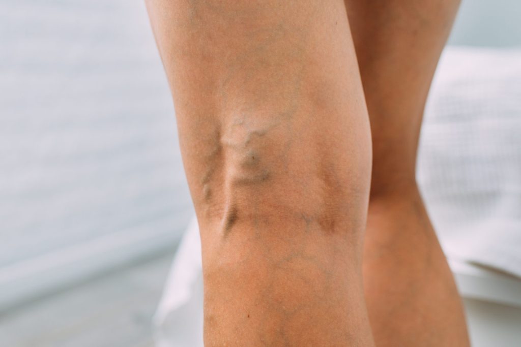 When Will You See Results in the Varicose Vein Treatment Timeline? banner